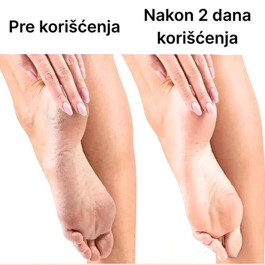 Jedina Električna Turpija za Glatke Pete Koja je Uspešna