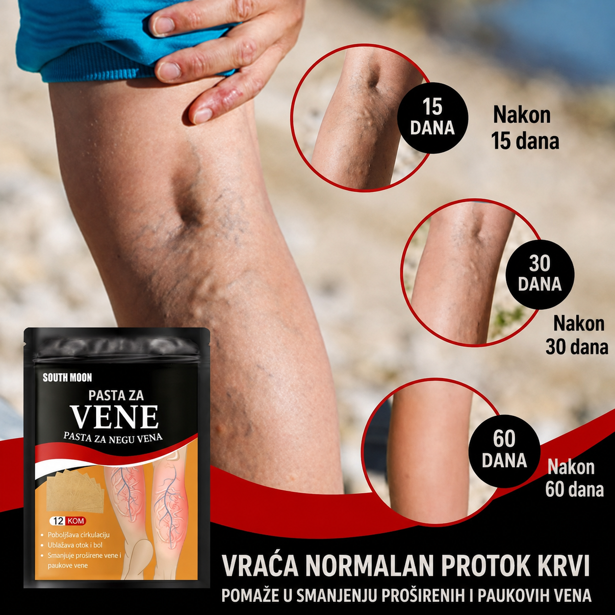 Flasteri za uklanjanje bolova od proširenih vena (pakovanje za mesec dana)