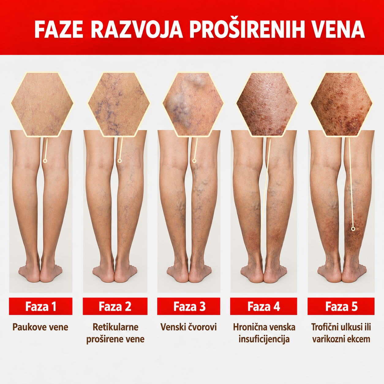 Flasteri za uklanjanje bolova od proširenih vena (pakovanje za mesec dana)