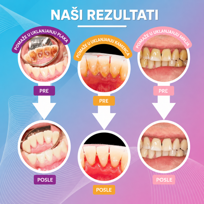 Ultrazvučni Interdentalni čistač za zubni plak i naslage