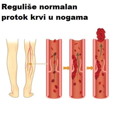 Flasteri za uklanjanje bolova od proširenih vena (pakovanje za mesec dana)